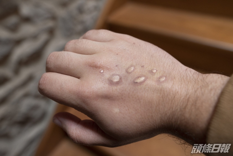 Monkeypox-Getty-2-Images-scaled