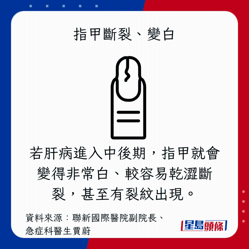肝臟過勞警號:指甲斷裂、變白