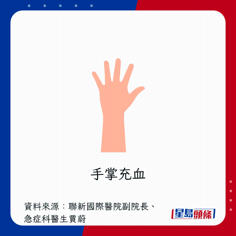 肝臟過勞警號:手掌充血