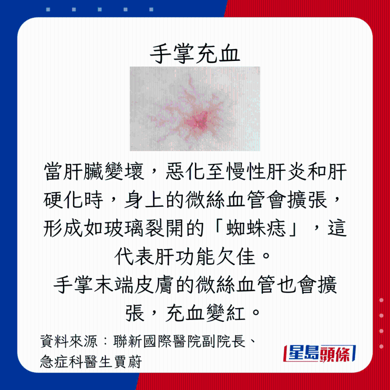 肝臟過勞警號:手掌充血