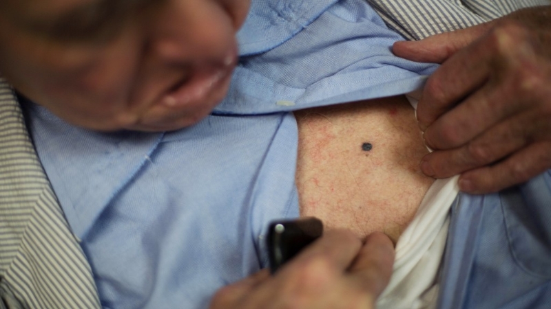 黑色素瘤在所有皮肤癌中死亡率最高。 美联社