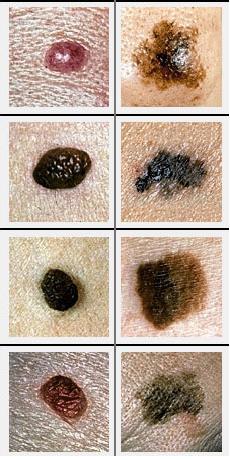 恶性黑色素瘤（右四图）会不对称、周界不明显、颜色不均，且多大于六毫米，与一般的痣（左四图）不同。 网上图片