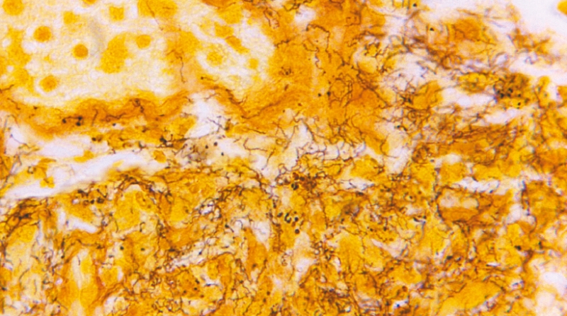 CDC最新数据,曾于国内绝迹的梅毒病例自2018年来急增80%。2022年录得超过20.7万宗,数量比前一年增加17.3%。 美联社 CDC最新数据,曾于国内绝迹的梅毒病例自2018年来急增80%。2022年录得超过20.7万宗,数量比前一年增加17.3%。 美联社