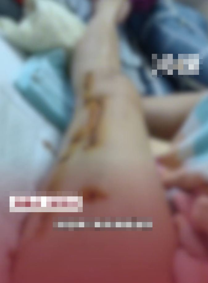 乐女士指,自己腿骨被压断,在医院内治疗。 乐女士指,自己腿骨被压断,在医院内治疗。