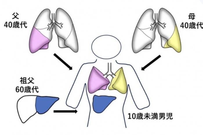 男童同时接受双亲及祖父捐出的部分肺与肝移植