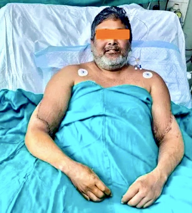 手术后库马尔 手术后库马尔