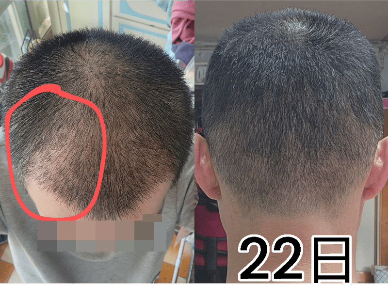 植发后第22日