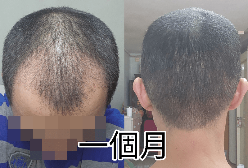 植发后1个月