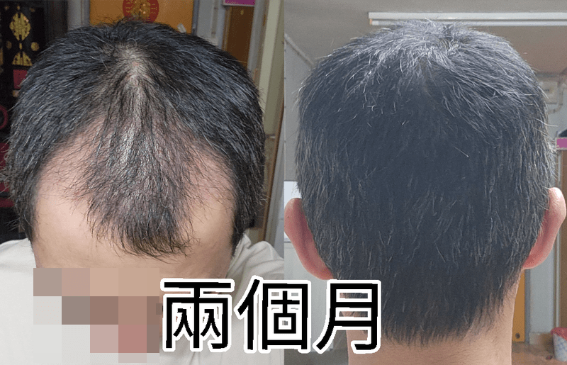植发后2个月