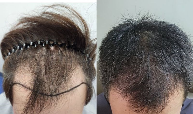 植发后差不多3个月