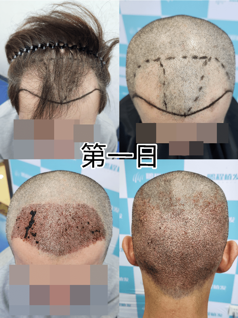 植发后第1日 植发后第1日