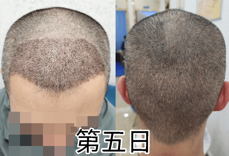 植发后第5日 植发后第5日