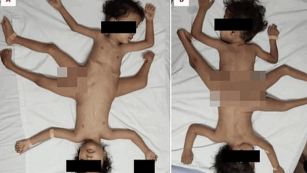 印尼连体婴 印尼连体婴