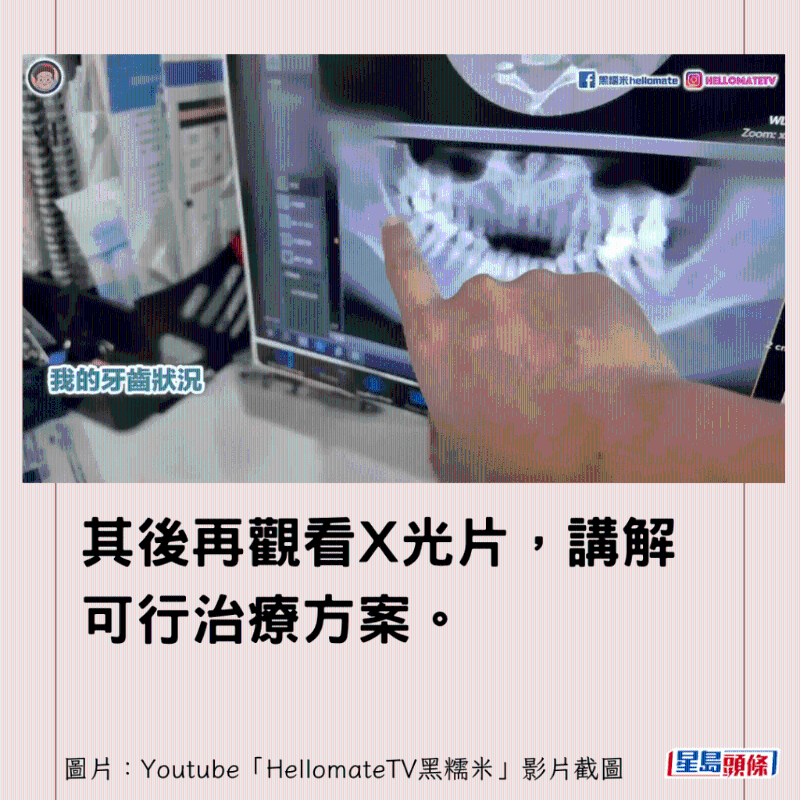 香港男子实测深圳平价洗牙种牙20