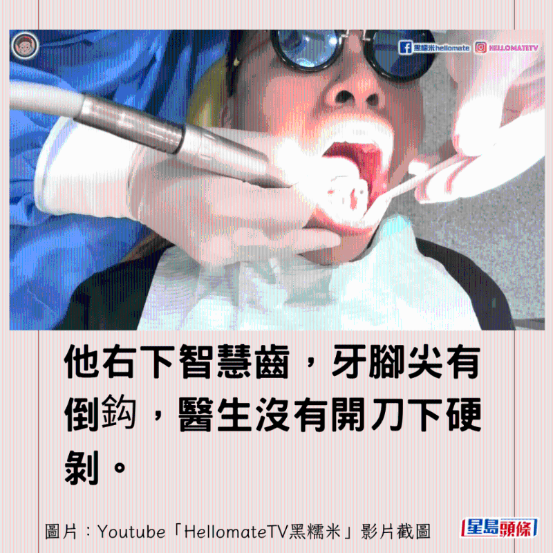 香港男子实测深圳平价洗牙种牙15
