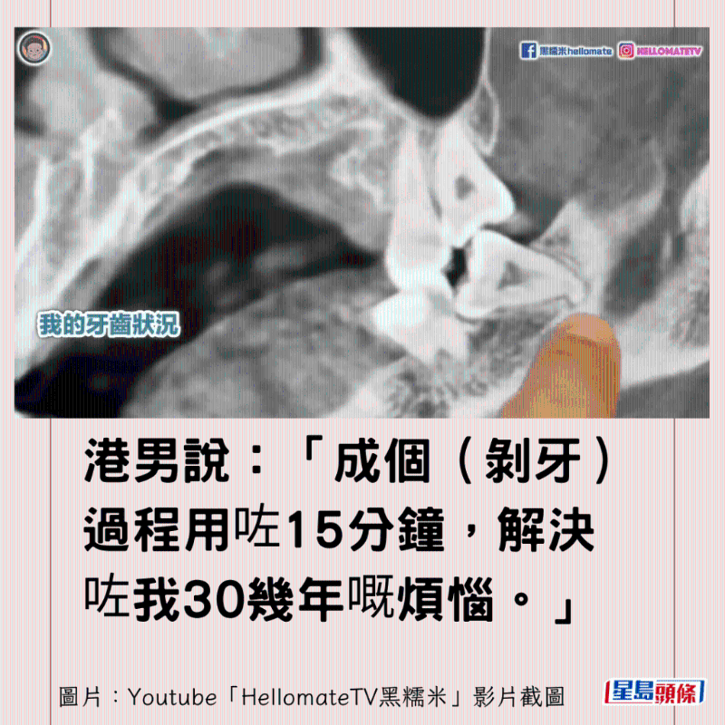 香港男子实测深圳平价洗牙种牙12