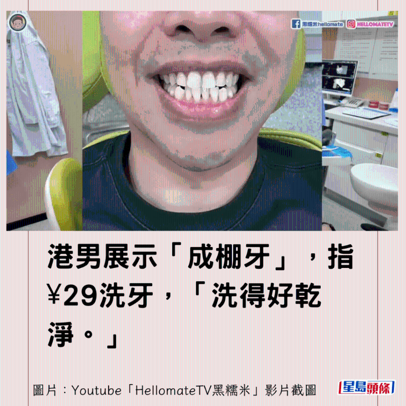 香港男子实测深圳平价洗牙种牙3