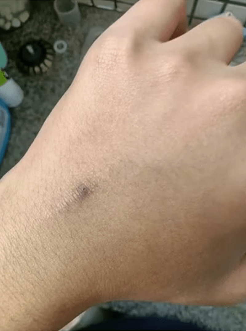 张先生全身多处疼痛、四肢出现瘀青、受伤后流血不止。 张先生全身多处疼痛、四肢出现瘀青、受伤后流血不止。