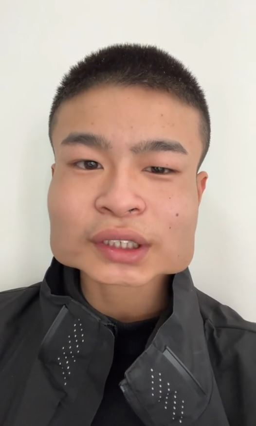 张果常食槟榔导致下颚变形如「四方果」。 张果常食槟榔导致下颚变形如「四方果」。