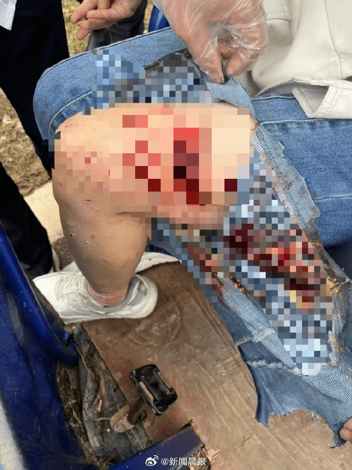 女子全身有10余处伤口,伤口最深处见骨。 女子全身有10余处伤口,伤口最深处见骨。