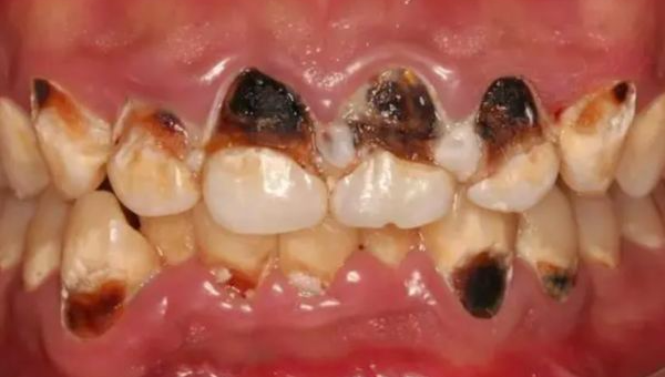 湖北17岁女孩一天喝5瓶可乐 湖北17岁女孩一天喝5瓶可乐