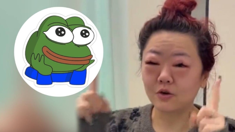 广东女子因吃太多车厘子,令双眼严重肿涨。 广东女子因吃太多车厘子,令双眼严重肿涨。