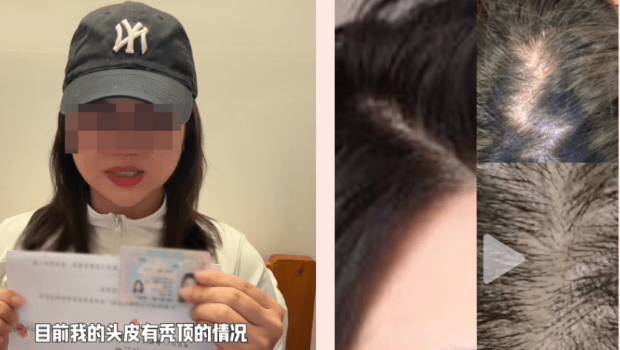 港女表示“目前我的头皮有秃顶的情况“。 港女表示“目前我的头皮有秃顶的情况“。