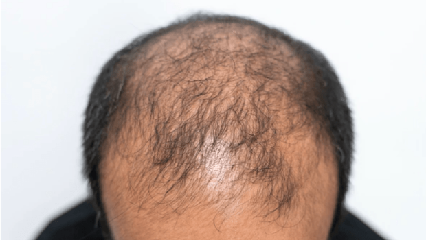 不明真菌袭印度多条村庄 不明真菌袭印度多条村庄