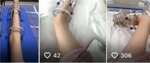 央视曝光断骨增高灰色产业链 央视曝光断骨增高灰色产业链