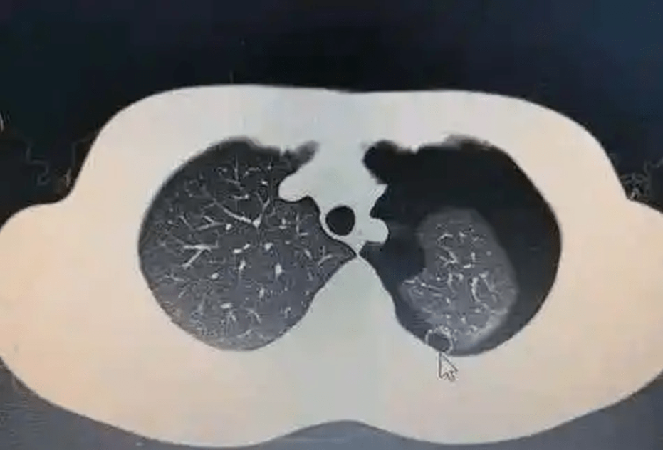 男子确诊为自发性气胸。 资料图片 男子确诊为自发性气胸。 资料图片