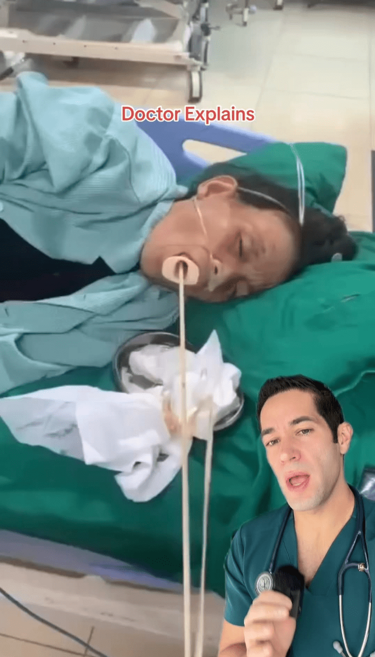 女子口中拉出超长寄生虫 女子口中拉出超长寄生虫