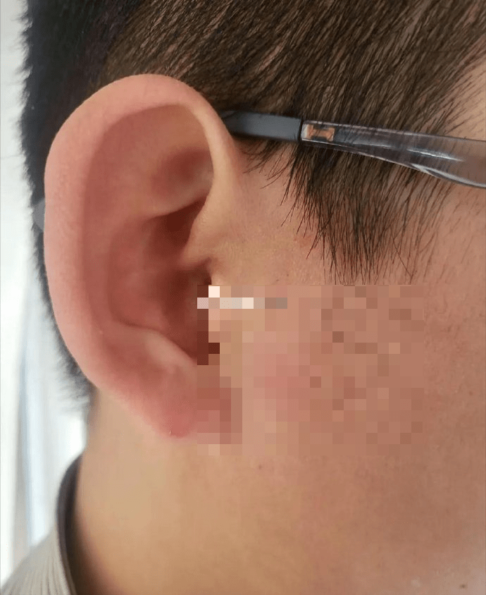 被刘姓老师打伤的学生脸部留有伤痕。 被刘姓老师打伤的学生脸部留有伤痕。