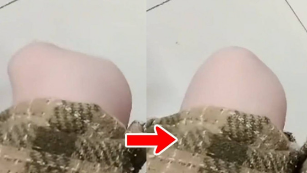 19岁女天生髌骨脱位 19岁女天生髌骨脱位