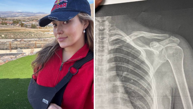 谷爱凌分享自己受伤的照片。 谷爱凌分享自己受伤的照片。