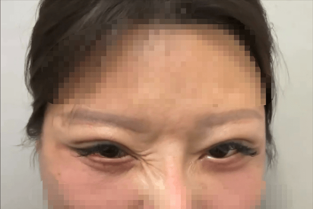 经过多年,王女士的眼部还不能修复。 经过多年,王女士的眼部还不能修复。