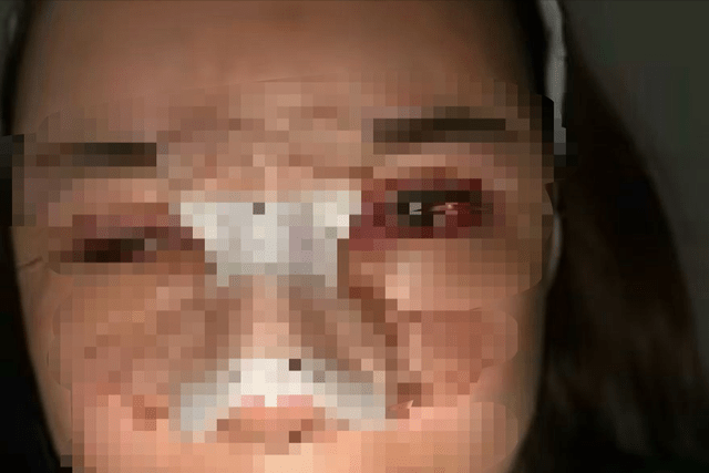 王女士接受整形手术后一周。 王女士接受整形手术后一周。