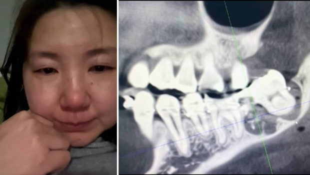 安徽女子疑因拔错智慧齿而轻生。 安徽女子疑因拔错智慧齿而轻生。