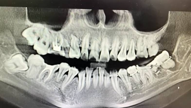 死者哥哥指妹妹被拔错智慧齿。九派新闻 死者哥哥指妹妹被拔错智慧齿。九派新闻