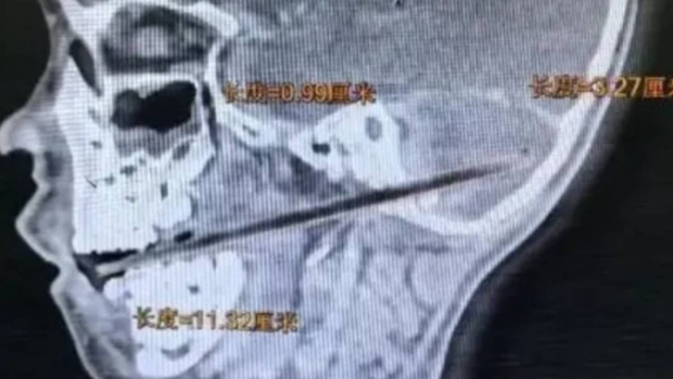 广东男童吃麦芽糖摔倒,竹签刺入小脑。 广东男童吃麦芽糖摔倒,竹签刺入小脑。