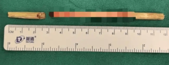 竹签被顺利取出。 竹签被顺利取出。