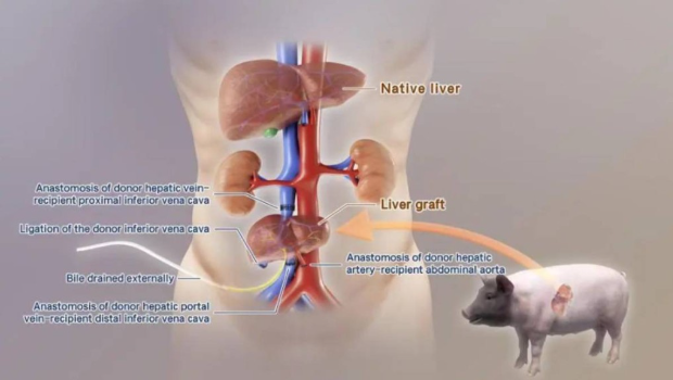 中国团队成功将基因编辑猪肝移植人体 中国团队成功将基因编辑猪肝移植人体