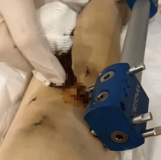 小梦在进行术后伤口清创。紫牛新闻 小梦在进行术后伤口清创。紫牛新闻