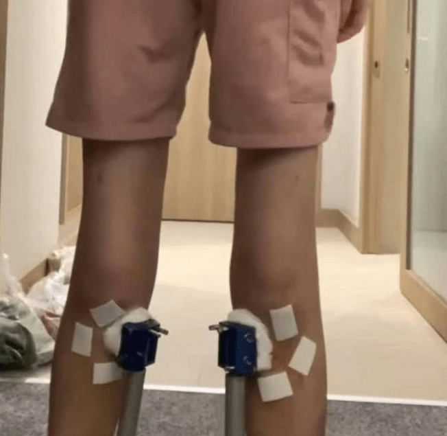 小梦的腿如今呈X型。紫牛新闻 小梦的腿如今呈X型。紫牛新闻