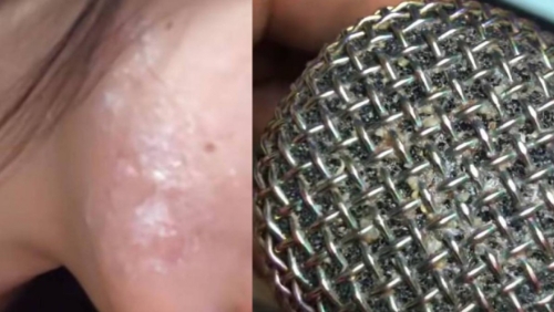 女子贴近咪高峰唱K染疱疹 女子贴近咪高峰唱K染疱疹