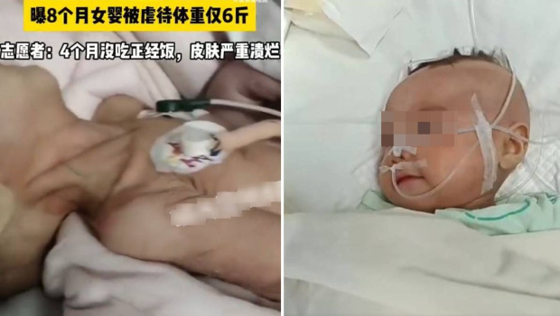 疑遭虐待的八个月大女婴,送院时(左)严重营养不良。 疑遭虐待的八个月大女婴,送院时(左)严重营养不良。