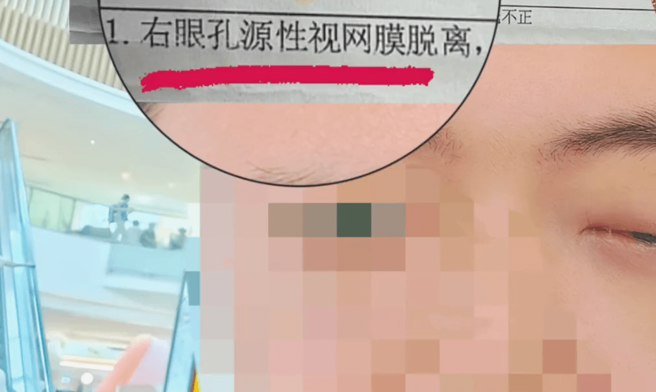 網購近視眼鏡出事,川男配戴4天視網膜脫落險失明。 黑貓投訴