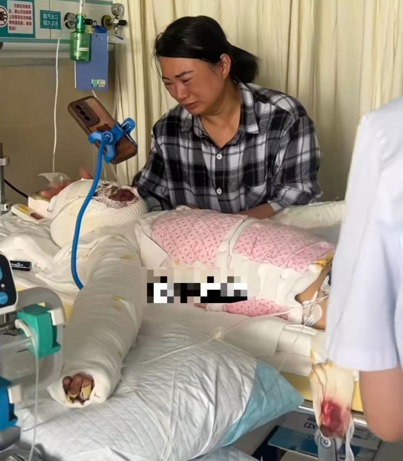 8岁女童开灯突然爆炸,全身58%烧伤 8岁女童开灯突然爆炸,全身58%烧伤