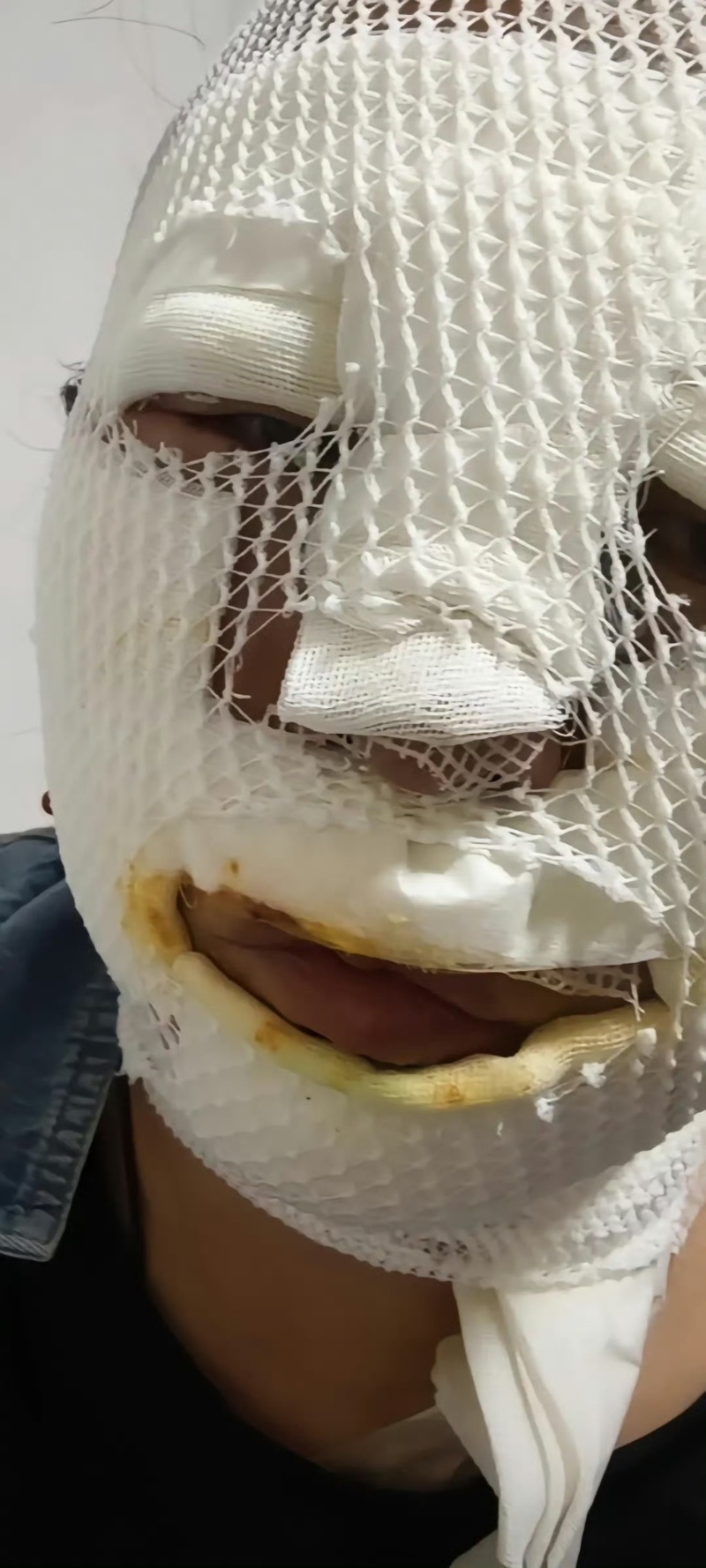 野外烧烤遇卡式炉爆炸多人被炸伤。 野外烧烤遇卡式炉爆炸多人被炸伤。