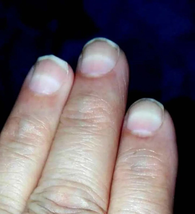 铊中毒患者“米氏纹”特征 铊中毒患者“米氏纹”特征