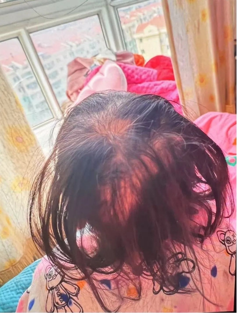 女孩大把脱发 女孩大把脱发